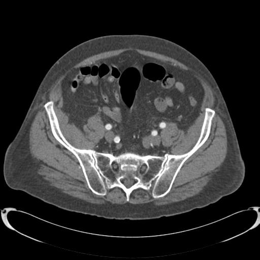 Aortic intramural hematoma (Radiopaedia 34260-35540 B 77).png