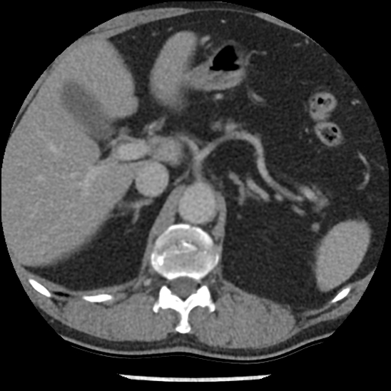 Aortic intramural hematoma (type B) (Radiopaedia 79323-92387 Axial C+ delayed 58).jpg