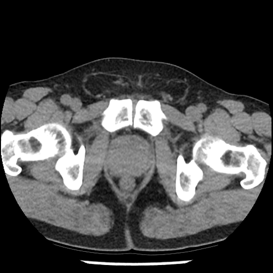 Aortic intramural hematoma (type B) (Radiopaedia 79323-92387 Axial non-contrast 115).jpg