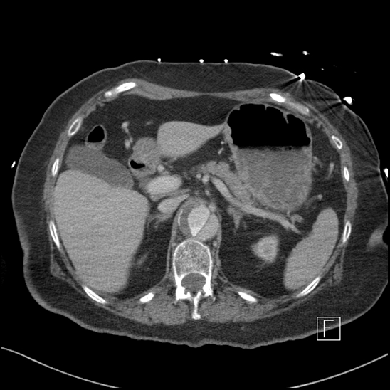 Aortic intramural hematoma with dissection and intramural blood pool (Radiopaedia 77373-89491 E 12).jpg