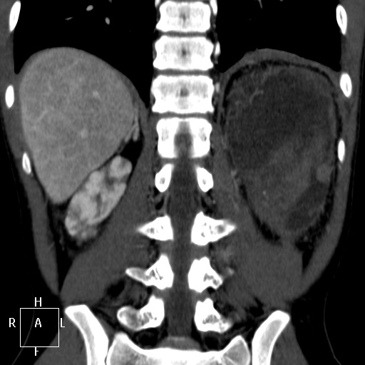 Aorto-left renal vein fistula (Radiopaedia 45534-49628 B 57).jpg