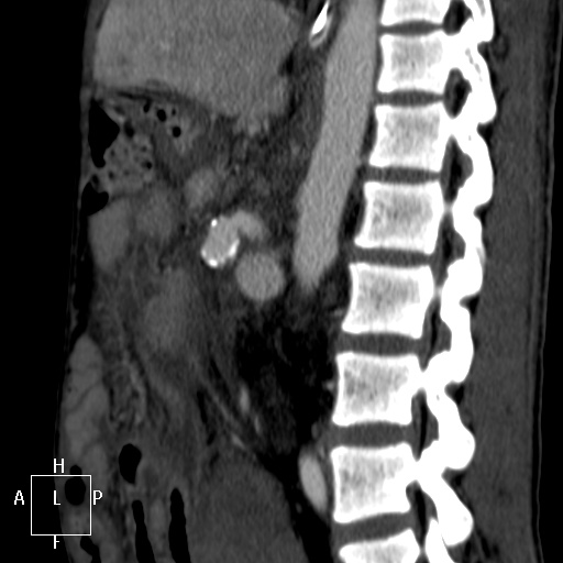 File:Aorto-left renal vein fistula (Radiopaedia 45534-49628 C 39).jpg