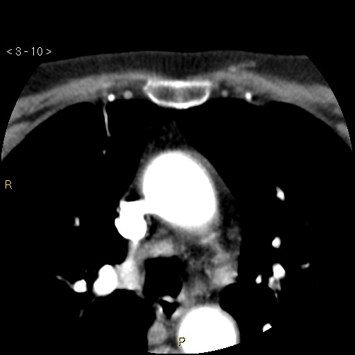 Aortoiliac occlusive disease (Radiopaedia 16828-16548 A 10).jpg