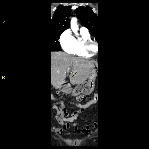 File:Aortoiliac occlusive disease (Radiopaedia 16828-16548 B 21).jpg