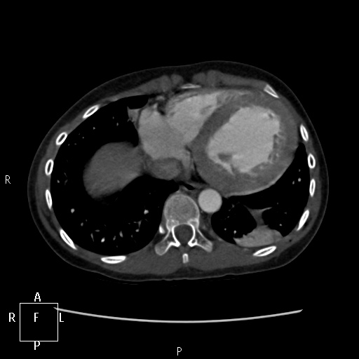 File:Aortopulmonary septal defect (Radiopaedia 41990-45013 Axial C+ CTPA 14).jpg