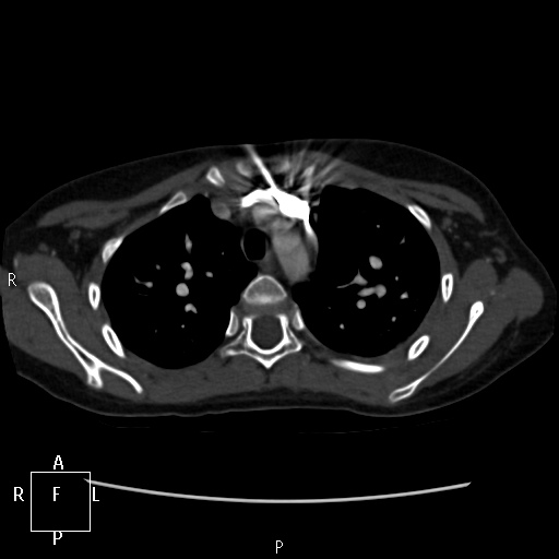 File:Aortopulmonary septal defect (Radiopaedia 41990-45013 Axial C+ CTPA 46).jpg