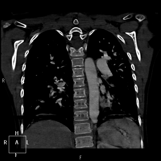 File:Aortopulmonary septal defect (Radiopaedia 41990-45013 Coronal C+ CTPA 49).jpg