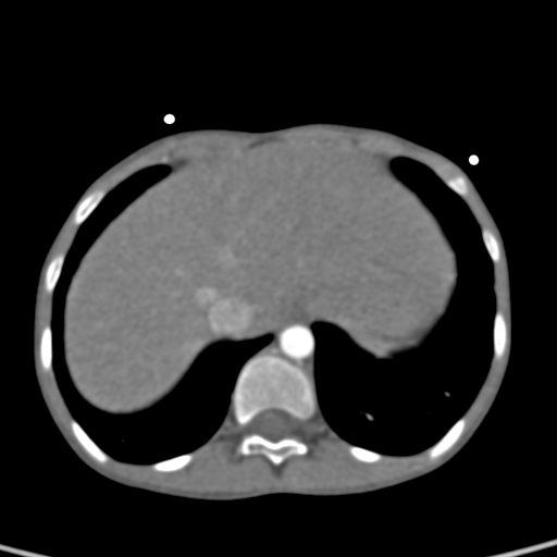 File:Aortopulmonary window, interrupted aortic arch and large PDA giving the descending aorta (Radiopaedia 35573-37074 B 83).jpg