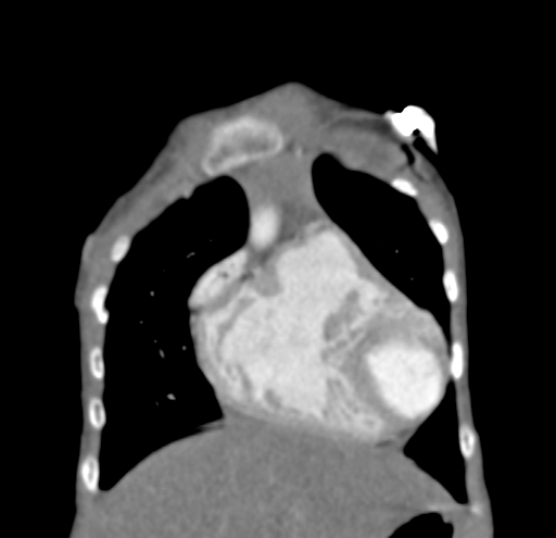 File:Aortopulmonary window, interrupted aortic arch and large PDA giving the descending aorta (Radiopaedia 35573-37074 D 10).jpg