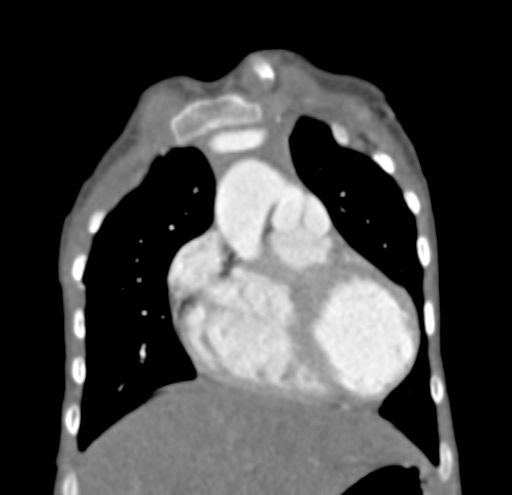 File:Aortopulmonary window, interrupted aortic arch and large PDA giving the descending aorta (Radiopaedia 35573-37074 D 14).jpg