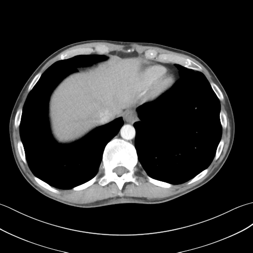 Apical pleural calcification (Radiopaedia 46141-50499 Axial C+ delayed 58).png