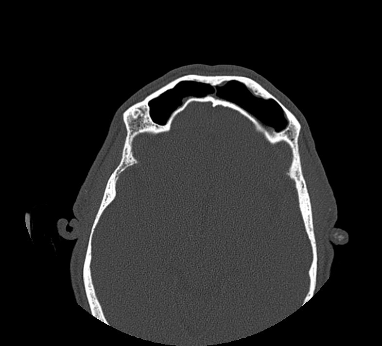 Aplastic maxillary sinuses (Radiopaedia 60030-67561 Axial non-contrast 60).jpg