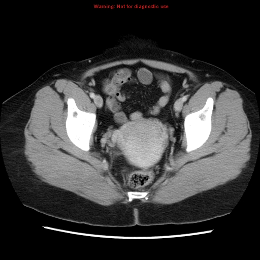 Appendiceal mucinous cystadenoma (Radiopaedia 8263-9111 Axial liver window 72).jpg