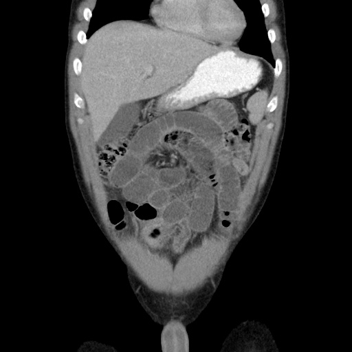 Appendicitis complicated by post-operative collection (Radiopaedia 35595-37114 B 16).jpg