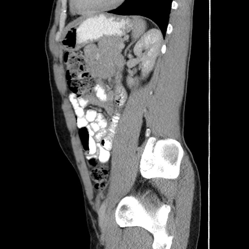 Appendicitis complicated by post-operative collection (Radiopaedia 35595-37114 C 49).jpg