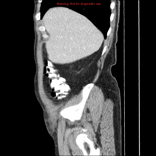 File:Appendicitis mass in inguinal hernia (Radiopaedia 26858-27029 C 6).jpg
