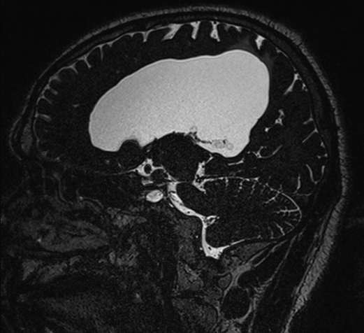 Aqueduct stenosis with spontaneous 3rd ventriculostomy (Radiopaedia 74381-85267 A 59).jpg
