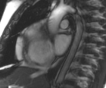File:Arrhythmogenic right ventricular cardiomyopathy (Radiopaedia 69431-79307 Short axis cine 245).jpg