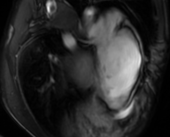 Arrhythmogenic right ventricular cardiomyopathy (Radiopaedia 69564-79464 4ch cine 123).jpg