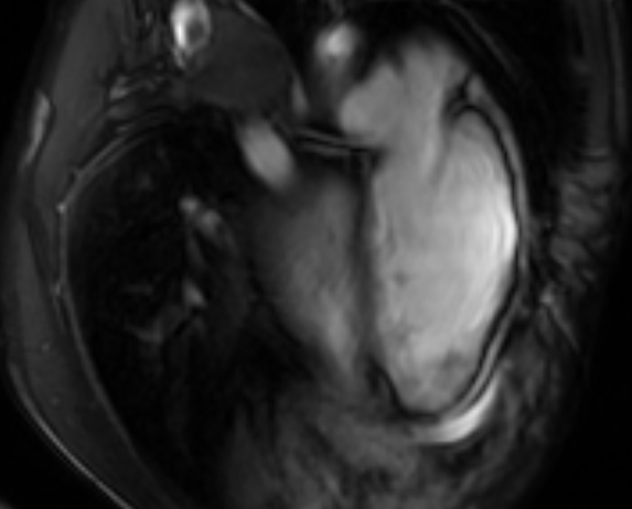 File:Arrhythmogenic right ventricular cardiomyopathy (Radiopaedia 69564-79464 4ch cine 135).jpg