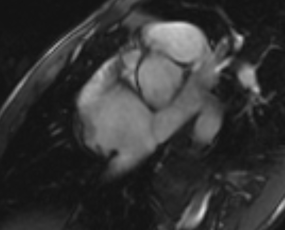Arrhythmogenic right ventricular cardiomyopathy (Radiopaedia 69564-79464 short axis cine 286).jpg