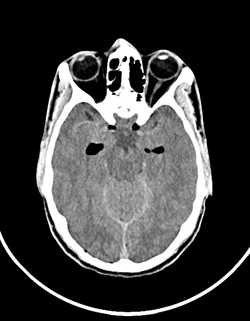 Arrow injury to the brain (Radiopaedia 72101-82607 Axial non-contrast 65).jpg
