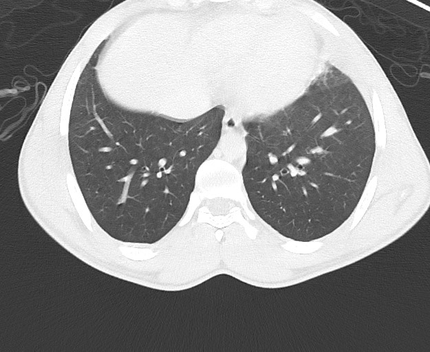 File:Arrow injury to the chest (Radiopaedia 75223-86321 Axial lung window 66).jpg