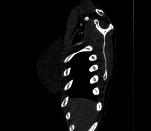 File:Arteria lusoria (Radiopaedia 88528-105192 C 17).jpg