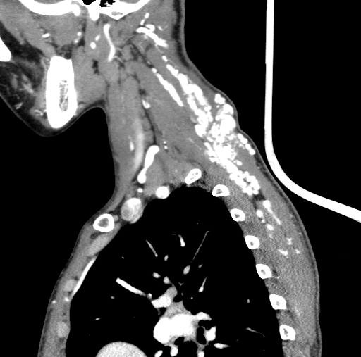 Arteriovenous malformation of the neck (Radiopaedia 53935-60062 C 29).jpg