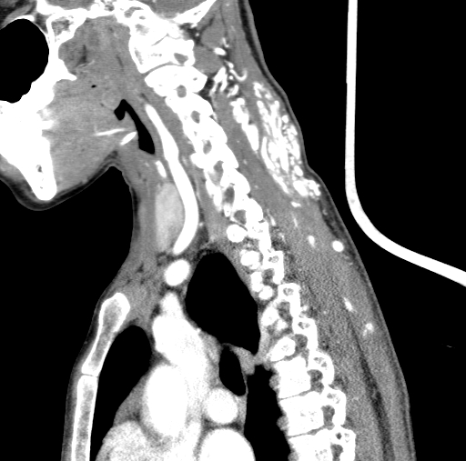 Arteriovenous malformation of the neck (Radiopaedia 53935-60062 C 52).jpg