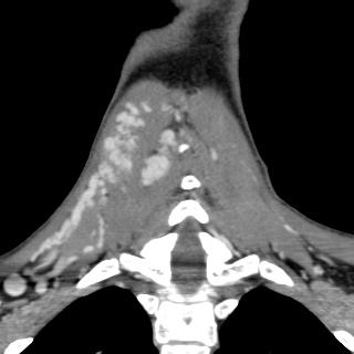 Arteriovenous malformation of the neck (Radiopaedia 53935-60062 D 39).jpg