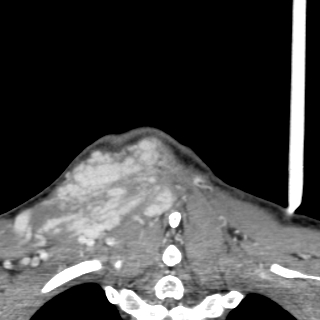Arteriovenous malformation of the neck (Radiopaedia 53935-60062 D 60).jpg