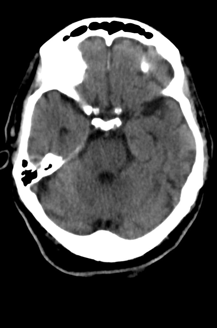 Artery of Percheron infarction (Radiopaedia 80613-94202 Axial non-contrast 67).jpg