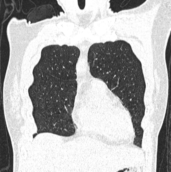 File:Aspergilloma (Radiopaedia 26223-26347 Coronal lung window 12).jpg