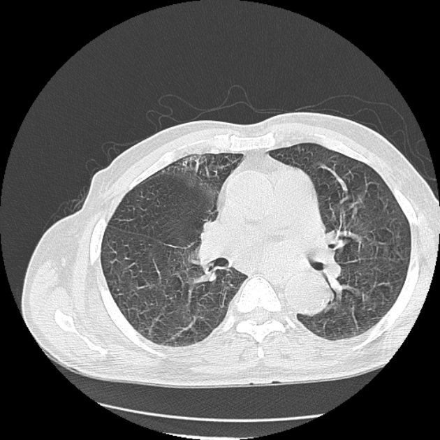 Aspergilloma (Radiopaedia 44592-48327 Axial lung window 42).jpg