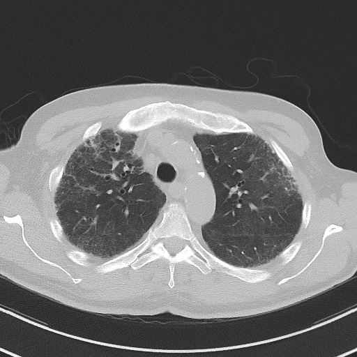 File:Aspergilloma on background pulmonary fibrosis (Radiopaedia 60942-68757 A 17).jpg
