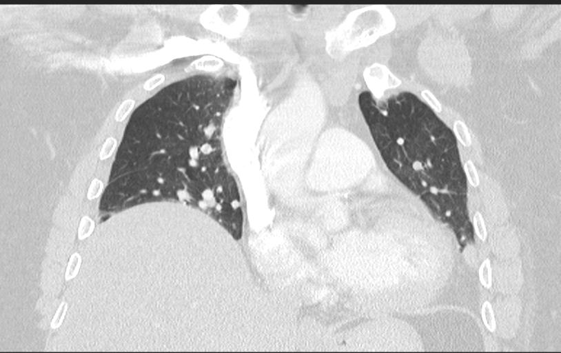 Aspirated tooth (Radiopaedia 28584-28844 Axial lung window 50).jpg