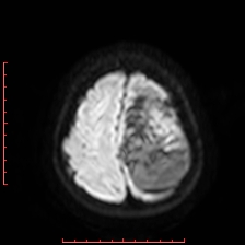 Astroblastoma (Radiopaedia 74287-85162 Axial DWI 95).jpg