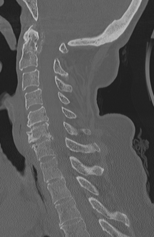 Atlanto-axial subluxation (Radiopaedia 36610-38176 Sagittal bone window 41).png
