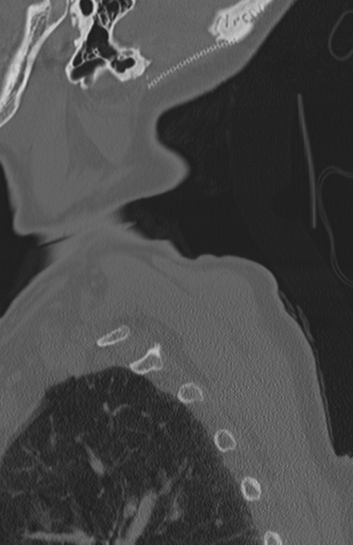 Atlanto-axial subluxation (Radiopaedia 36610-38176 Sagittal bone window 72).png