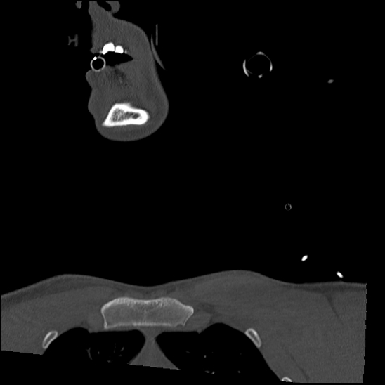 Atlanto-occipital dissociation (Traynelis type 1), C2 teardrop fracture, C6-7 facet joint dislocation (Radiopaedia 87655-104061 Coronal bone window 1).jpg