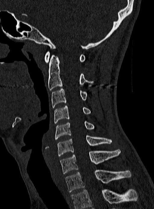 Atlantoaxial subluxation (Radiopaedia 44681-48450 Sagittal bone window 79).jpg