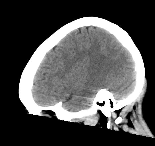 File:Atretic encephalocoele with inferior vermis hypoplasia (Radiopaedia 30443-31107 C 8).jpg