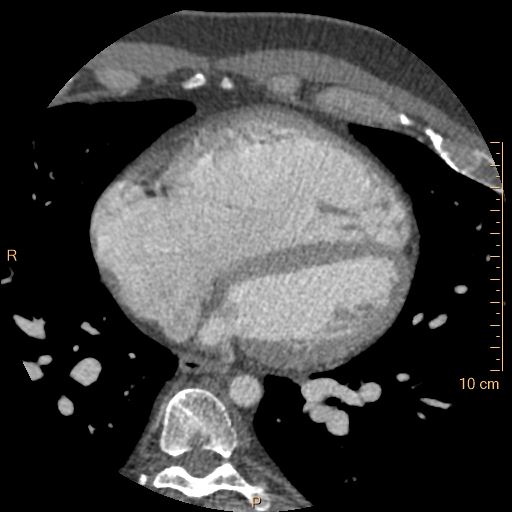 Atrial septal defect (upper sinus venosus type) with partial anomalous pulmonary venous return into superior vena cava (Radiopaedia 73228-83961 A 170).jpg