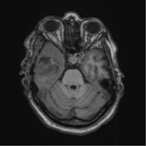 Atypical meningioma (WHO Grade II) (Radiopaedia 54742-60981 Axial T1 21).png
