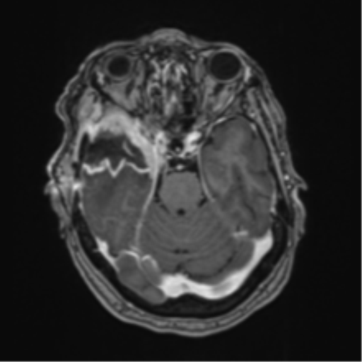 Atypical meningioma (WHO Grade II) (Radiopaedia 54742-60981 Axial T1 C+ 23).png