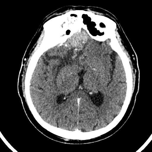 Atypical meningioma (WHO grade II) with brain invasion (Radiopaedia 57767-64728 Axial C+ 29).png