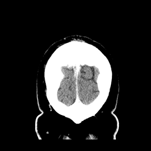 Atypical meningioma (WHO grade II) with brain invasion (Radiopaedia 57767-64728 Coronal C+ 59).png