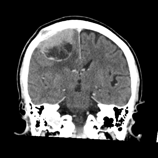 Atypical meningioma (WHO grade II) with osseous invasion (Radiopaedia 53654-59715 Coronal C+ delayed 33).png