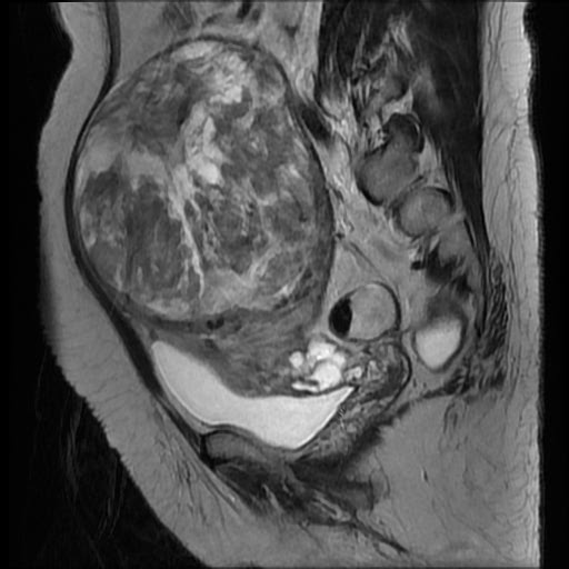 File:Atypical retroperitoneal lymphocoeles with large leiomyoma of uterus (Radiopaedia 32084-33027 Sagittal T2 20).jpg